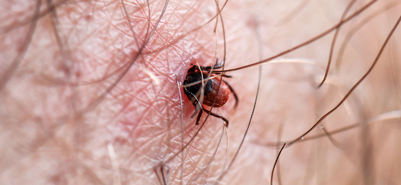 Close-up of a tick embedded in human skin, surrounded by fine hairs. The tick's dark body contrasts with the pale skin, conveying a sense of caution.