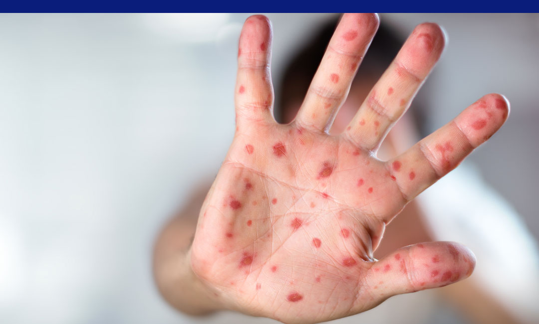 A hand with red spots, possibly indicating a rash or infection, is prominently held up. The blurred background suggests a neutral indoor setting.
